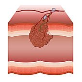 Tumour, illustration