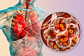 Coronavirus disease of the lungs, conceptual illustration