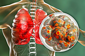 Coronavirus disease of the lungs, conceptual illustration