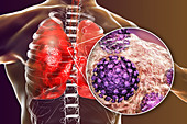 Coronavirus disease of the lungs, conceptual illustration