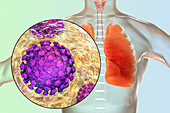 Coronavirus disease of the lungs, conceptual illustration