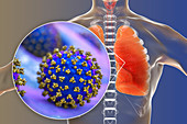 Coronavirus disease of the lungs, conceptual illustration