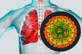 Coronavirus disease of the lungs, conceptual illustration