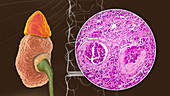 Chronic kidney disease, illustration and light micrograph