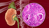 Chronic kidney disease, illustration and light micrograph