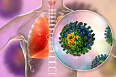 Coronavirus disease of the lungs, conceptual illustration