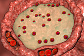 Covid-19 infection, illustration