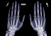 Two outstretched hands, X-ray