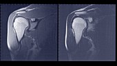 Shoulder joint, MRI