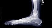 Foot and ankle, X-ray