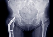 Pelvis with plated leg bone, X-ray
