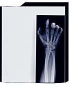Hand and arm with curled fingers, X-ray