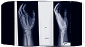 Film of two hands, X-ray