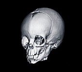 Image of baby's head, CT scan