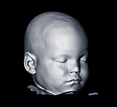Image of baby's head, CT scan