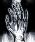 Human hand over spine, X-ray