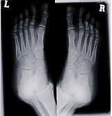Human feet, X-ray