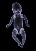 Baby doll, X-ray