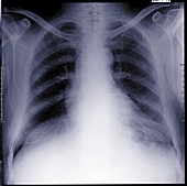 Chest, X-ray