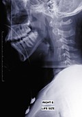 Skull and neck, X-ray
