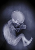 Baby in a fetal position, X-ray
