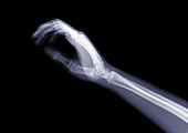 Hand and arm from the side, X-ray