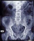 Human pelvis, X-ray