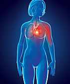 Myocardial infarction, illustration