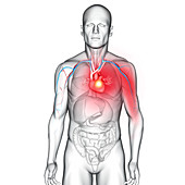 Myocardial infarction, illustration