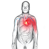 Myocardial infarction, illustration