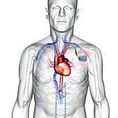 Pacemaker, illustration