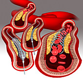 Angioplasty with stent placement, illustration