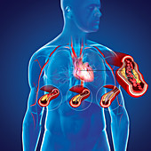 Angioplasty with stent placement, illustration