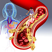 Cholesterol, illustration