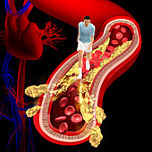 Cholesterol, illustration