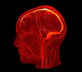 Brain veins and venous sinuses, MRI angiogram