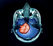 Acoustic neuroma tumour, MRI scan