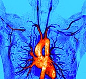 Thoracic outlet syndrome, MRI angiogram