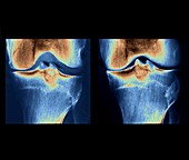 Knee osteoarthritis, X-rays