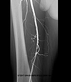 Leg artery angioplasty, angiogram