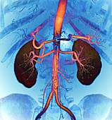 Healthy kidneys, CT scan