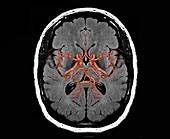 Brain arteries, 3D MRI scan