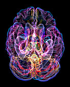 Alzheimer's disease, 3D MRI scan