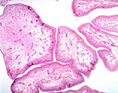 Botryoid rhabdomyosarcoma, light micrograph