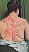 Keloid scar, historical image