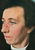 Lupus erythematosus, historical image
