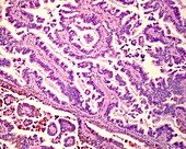 Human renal cell carcinoma, light micrograph