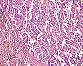 Human renal cell carcinoma, light micrograph
