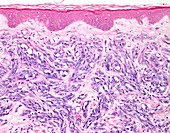 Angiosarcoma of skin, light micrograph