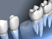 Missing tooth, illustration